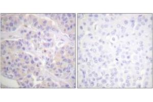 Immunohistochemistry analysis of paraffin-embedded human breast carcinoma tissue, using p130 Cas (Ab-165) Antibody. (BCAR1 anticorps  (AA 131-180))
