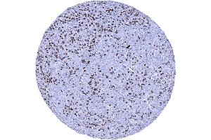 Squamous cell carcinoma containing numerous CD8 positive tumor infiltrating lymphocytes