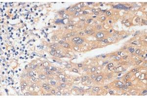 Immunohistochemistry of paraffin-embedded Human liver cancer using WNK3 Polyclonal Antibody at dilution of 1:100 (40x lens). (WNK3 anticorps)