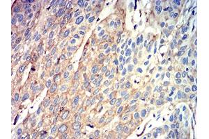 Immunohistochemical analysis of paraffin-embedded esophageal cancer tissues using ATG3 mouse mAb with DAB staining. (ATG3 anticorps  (AA 1-100))