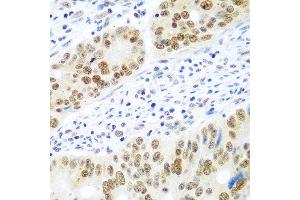 Immunohistochemistry of paraffin-embedded human colon carcinoma using MDC1 antibody at dilution of 1:100 (40x lens). (MDC1 anticorps)