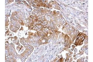 IHC-P Image Fatty Acid Synthase antibody [N1], N-term detects Fatty Acid Synthase protein at cytoplasm on human colon carcinoma by immunohistochemical analysis.