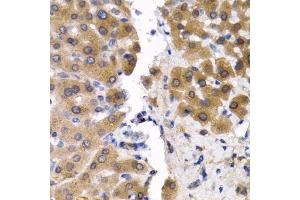 Immunohistochemistry of paraffin-embedded human liver cancer using SCP2 antibody.