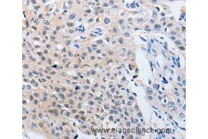 Immunohistochemistry of Human lung cancer using YWHAQ Polyclonal Antibody at dilution of 1:50 (14-3-3 theta anticorps)