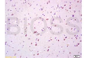 Formalin-fixed and paraffin embedded human glioma tissue labeled with Anti-CYP3A4 Polyclonal Antibody, Unconjugated (ABIN733793) at 1:200 followed by conjugation to the secondary antibody and DAB staining