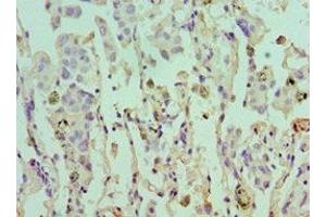 Immunohistochemistry of paraffin-embedded human lung cancer using ABIN7152105 at dilution of 1:100 (EIF4A1 anticorps  (AA 167-406))