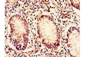 Immunohistochemistry of paraffin-embedded human colon cancer using ABIN7145632 at dilution of 1:100 (C10ORF32 anticorps  (AA 2-105))