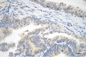 Immunohistochemistry was performed on paraffin-embedded human endometrial carcinoma using P70 S6 kinase beta antibody (ABIN7800226), 1:200).
