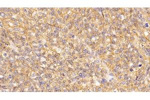 Detection of ATP1a1 in Human Ovarian cancer Tissue using Monoclonal Antibody to ATPase, Na+/K+ Transporting Alpha 1 Polypeptide (ATP1a1)