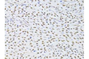 Immunohistochemistry of paraffin-embedded human adenomyosis using FKBP4 Antibody.