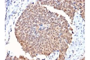 Formalin-fixed, paraffin-embedded human Breast Cancer stained with FAF1 Mouse Monoclonal Antibody (CPTC-FAF1-2).