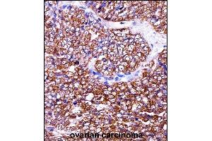 BAG2 Antibody (C-term) ((ABIN657974 and ABIN2846920))immunohistochemistry analysis in formalin fixed and paraffin embedded human ovarian carcinoma followed by peroxidase conjugation of the secondary antibody and DAB staining. (BAG2 anticorps  (C-Term))