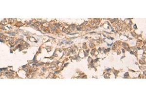 Immunohistochemistry of paraffin-embedded Human ovarian cancer tissue using ATR Polyclonal Antibody at dilution of 1:60(x200)