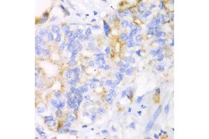 Immunohistochemistry of paraffin-embedded human liver cancer using CHIA antibody at dilution of 1:100 (x40 lens).