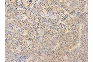 ABIN6255115 and ABIN6267636 at 1/100 staining human pituitary adenoma by IHC-P.