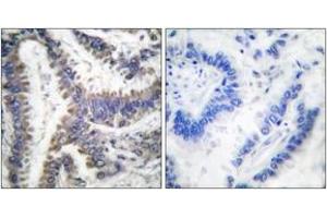 Immunohistochemistry analysis of paraffin-embedded human lung carcinoma, using DFF45 (Cleaved-Asp224) Antibody.