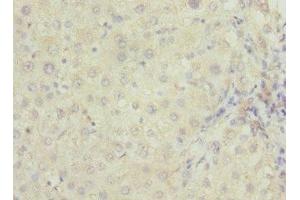 Immunohistochemistry of paraffin-embedded human liver cancer using ABIN7167252 at dilution of 1:100 (RAB23 anticorps  (AA 1-237))