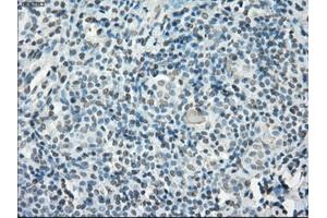 Immunohistochemical staining of paraffin-embedded Adenocarcinoma of ovary tissue using anti-PORmouse monoclonal antibody. (POR anticorps)
