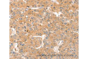 Immunohistochemistry of Human liver cancer using SMOC2 Polyclonal Antibody at dilution of 1:35