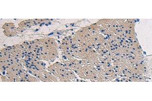 Immunohistochemistry of paraffin-embedded Human gastric cancer tissue using COL17A1 Polyclonal Antibody at dilution of 1:50(x200)