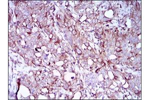 Immunohistochemical analysis of paraffin-embedded cervical cancer tissues using SYCP3 mouse mAb with DAB staining. (SYCP3 anticorps  (AA 27-128))