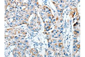 The image on the left is immunohistochemistry of paraffin-embedded Human breast cancer tissue using ABIN7128282(AGA Antibody) at dilution 1/20, on the right is treated with fusion protein.