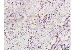 Formalin-fixed and paraffin embedded human esophageal carcinoma tissue labeled with Anti-CD86/B7-2 Polyclonal Antibody (ABIN736701), Unconjugated at 1:200 followed by conjugation to the secondary antibody and DAB staining (CD86 anticorps  (AA 140-175))