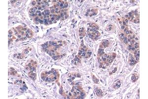 DAB staining on IHC-P; Samples: Human Liver cancer Tissue (Complement C4 anticorps  (AA 975-1336))