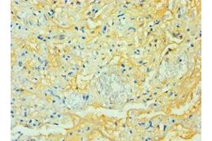 Immunohistochemistry of paraffin-embedded human lung tissue using ABIN7171585 at dilution of 1:100 (TTBK2 anticorps  (AA 1185-1244))