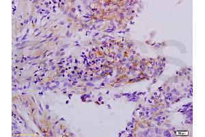 Formalin-fixed and paraffin embedded human laryngeal cancer labeled with Anti-APOH Polyclonal Antibody, Unconjugated (ABIN731483) at 1:200 followed by conjugation to the secondary antibody and DAB staining. (APOH anticorps  (AA 281-345))