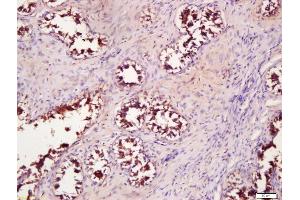 Formalin-fixed and paraffin embedded human breast carcinoma labeled with Anti-WNT4 Polyclonal Antibody, Unconjugated (ABIN762911) at 1:200 followed by conjugation to the secondary antibody and DAB staining (WNT4 anticorps  (AA 201-300))