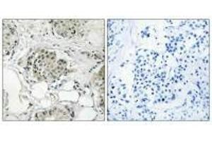 Immunohistochemistry analysis of paraffin-embedded human breast carcinoma tissue, using USP13 antibody.
