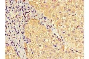 Immunohistochemistry of paraffin-embedded human liver cancer using ABIN7151414 at dilution of 1:100 (EFCAB7 anticorps  (AA 1-158))