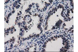 Immunohistochemical staining of paraffin-embedded Carcinoma of Human thyroid tissue using anti-HDHD1A mouse monoclonal antibody. (HDHD1 anticorps)