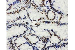 Anti-HDAC3 antibody,  IHC(P) IHC(P): Human Intestinal Cancer Tissue