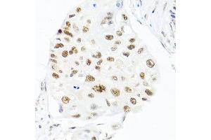 Immunohistochemistry of paraffin-embedded human lung cancer using THOC1 antibody. (THOC1 anticorps  (AA 428-657))