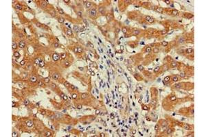 Immunohistochemistry of paraffin-embedded human liver cancer using ABIN7149738 at dilution of 1:100 (DEPDC1B anticorps  (AA 343-529))