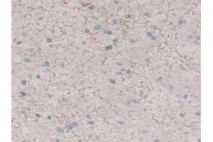 IHC-P analysis of Human Glioma Tissue, with DAB staining. (IL-8 anticorps  (AA 23-101))