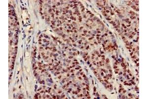 Immunohistochemistry of paraffin-embedded human ovarian cancer using ABIN7151782 at dilution of 1:100 (NEDD9 anticorps  (AA 68-151))