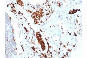 Formalin-fixed, paraffin-embedded human Lung Adenocarcinoma stained with Napsin A Rabbit Recombinant Monoclonal Antibody (NAPSA/1865R).