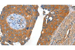 Immunohistochemistry of paraffin-embedded Human cervical cancer using ACOT11 Polyclonal Antibody at dilution of 1:40