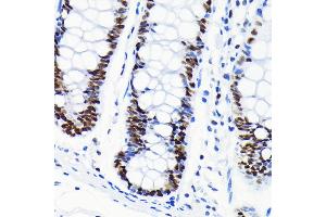 Immunohistochemistry of paraffin-embedded human colon using Chk2 antibody (ABIN7266294) at dilution of 1:100 (40x lens). (CHEK2 anticorps)