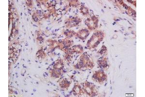 Formalin-fixed and paraffin embedded human breast cancer tissue labeled with Anti-Mitofusin 2 Polyclonal Antibody, Unconjugated  at 1:200 followed by conjugation to the secondary antibody and DAB staining.