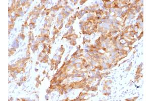 Formalin-fixed, paraffin-embedded human Prostate Carcinoma stained with Aurora B Mouse Monoclonal Antibody (AURKB/1592). (Aurora Kinase B anticorps  (AA 89-251))