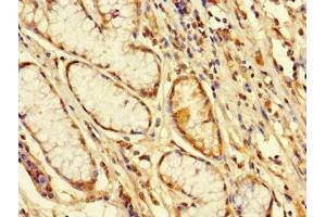 Immunohistochemistry of paraffin-embedded human gastric cancer using ABIN7152491 at dilution of 1:100 (FBXW12 anticorps  (AA 1-250))