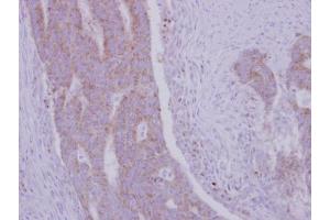 IHC-P Image Immunohistochemical analysis of paraffin-embedded human colon carcinoma, using RRM1, antibody at 1:500 dilution. (RRM1 anticorps  (Center))