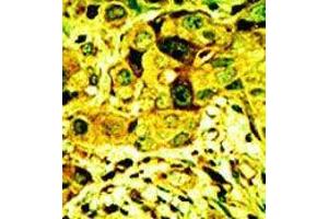 Formalin-fixed and paraffin-embedded human cancer tissue reacted with the primary antibody, which was peroxidase-conjugated to the secondary antibody, followed by AEC staining.
