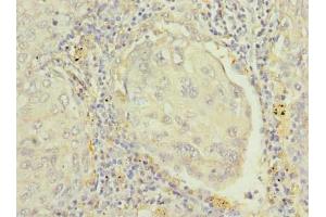 Immunohistochemistry of paraffin-embedded human lung cancer using ABIN7167399 at dilution of 1:100 (RAP1B anticorps  (AA 1-181))
