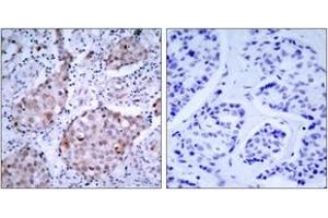 Immunohistochemistry analysis of paraffin-embedded human breast carcinoma, using HER2 (Phospho-Tyr1221/Tyr1222) Antibody. (ErbB2/Her2 anticorps  (pTyr1221))