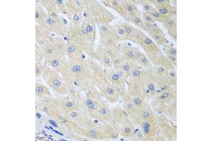 Immunohistochemistry of paraffin-embedded human liver cancer using PON1 antibody at dilution of 1:100 (40x lens). (PON1 anticorps)